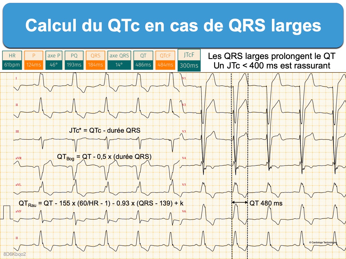 Qrs на экг что это. Расширение комплекса QRS на ЭКГ. Расширенный комплекс QRS на ЭКГ. Комплекс QRS 0.05. QRS 160мс.