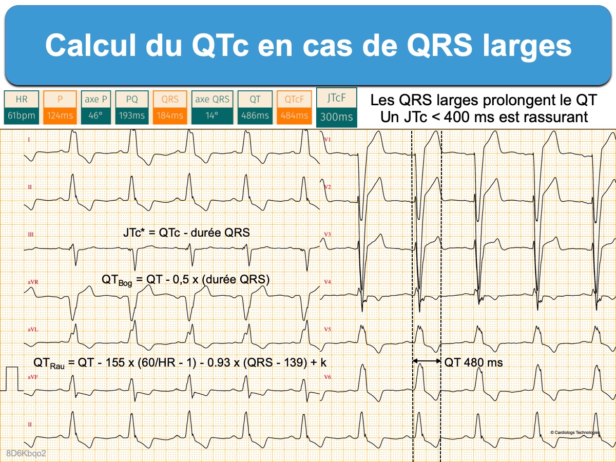 Qrs на экг что это