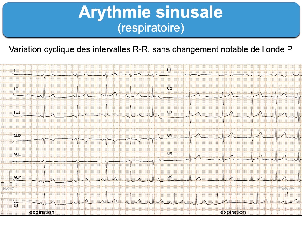Arythmie sinusale respiratoire : e-cardiogram