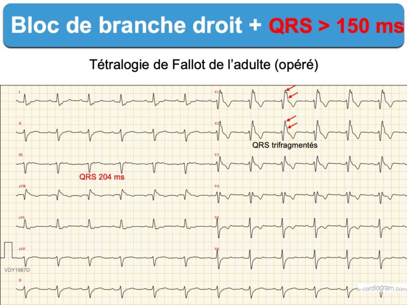 Bloc De Branche 2 Droit Complet E cardiogram bloc-de-branche-2-droit-complet-e-cardiogram