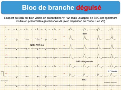 Bloc De Branche 2 Droit Complet E cardiogram bloc-de-branche-2-droit-complet-e-cardiogram