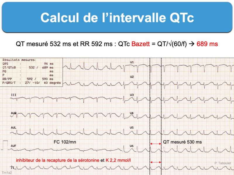Ecg Con Qtc Come Si Fa Intervalle QT. 2. QT corrigé (QTc) : e-cardiogram