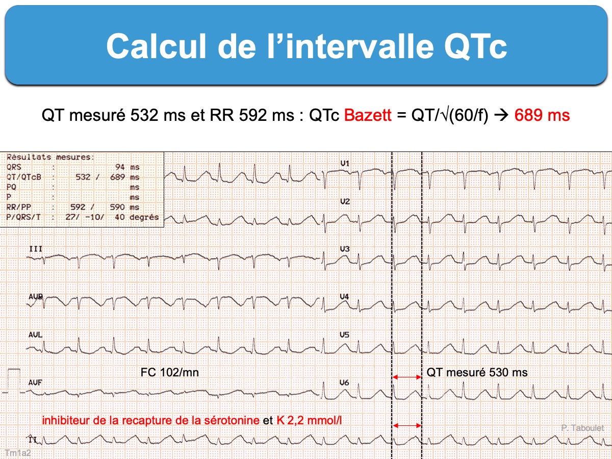 imagen Regresa etiqueta Intervalle QT. 2. QT corrigé (QTc) : e-cardiogram