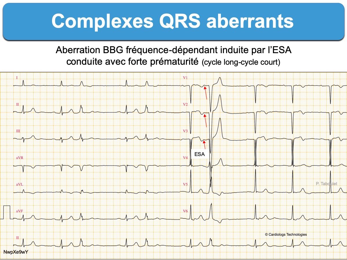 Qrs на экг что это. Широкий комплекс QRS на ЭКГ. Комплекс QRS В v1 типа RSR’. Узкий комплекс QRS на ЭКГ. Расширение комплекса QRS В v1.