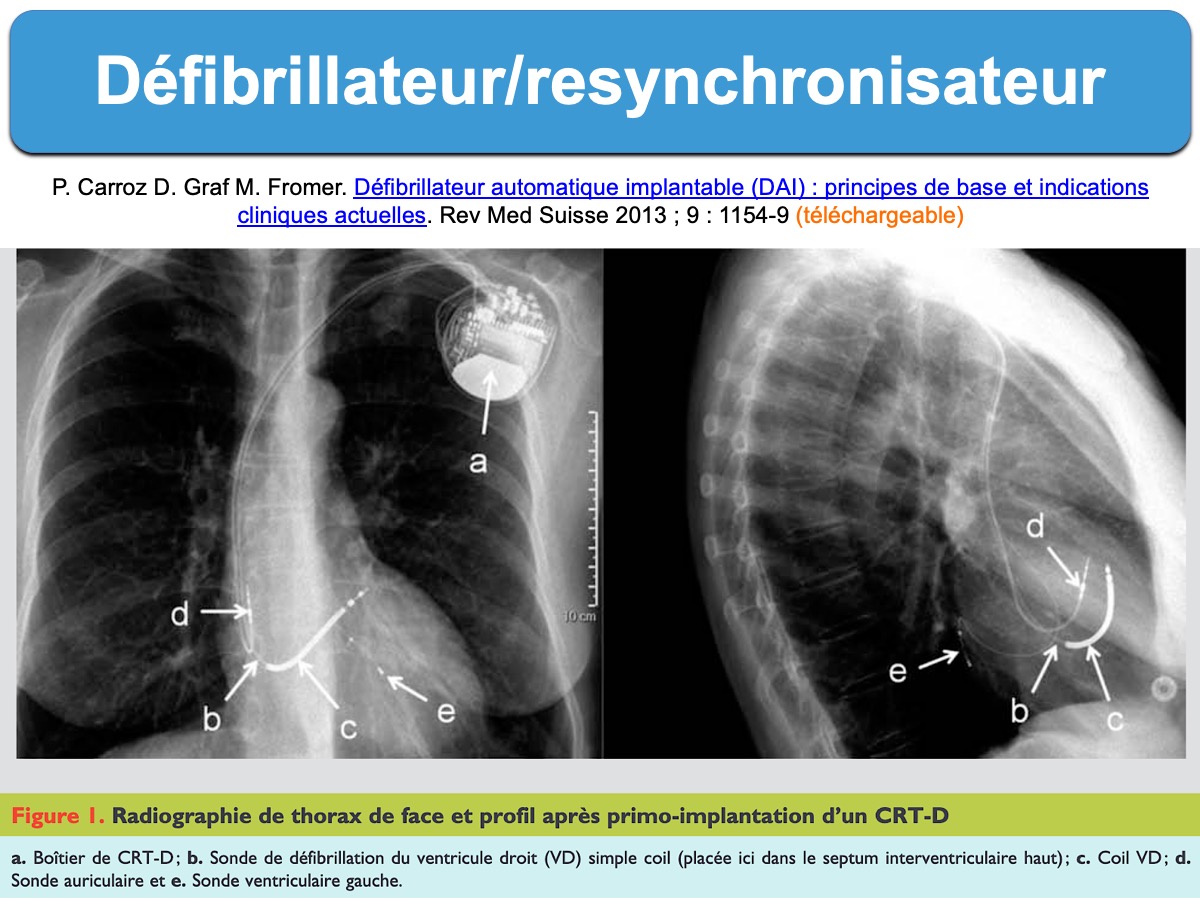 Defibrillateur Implantable Dai E Cardiogram