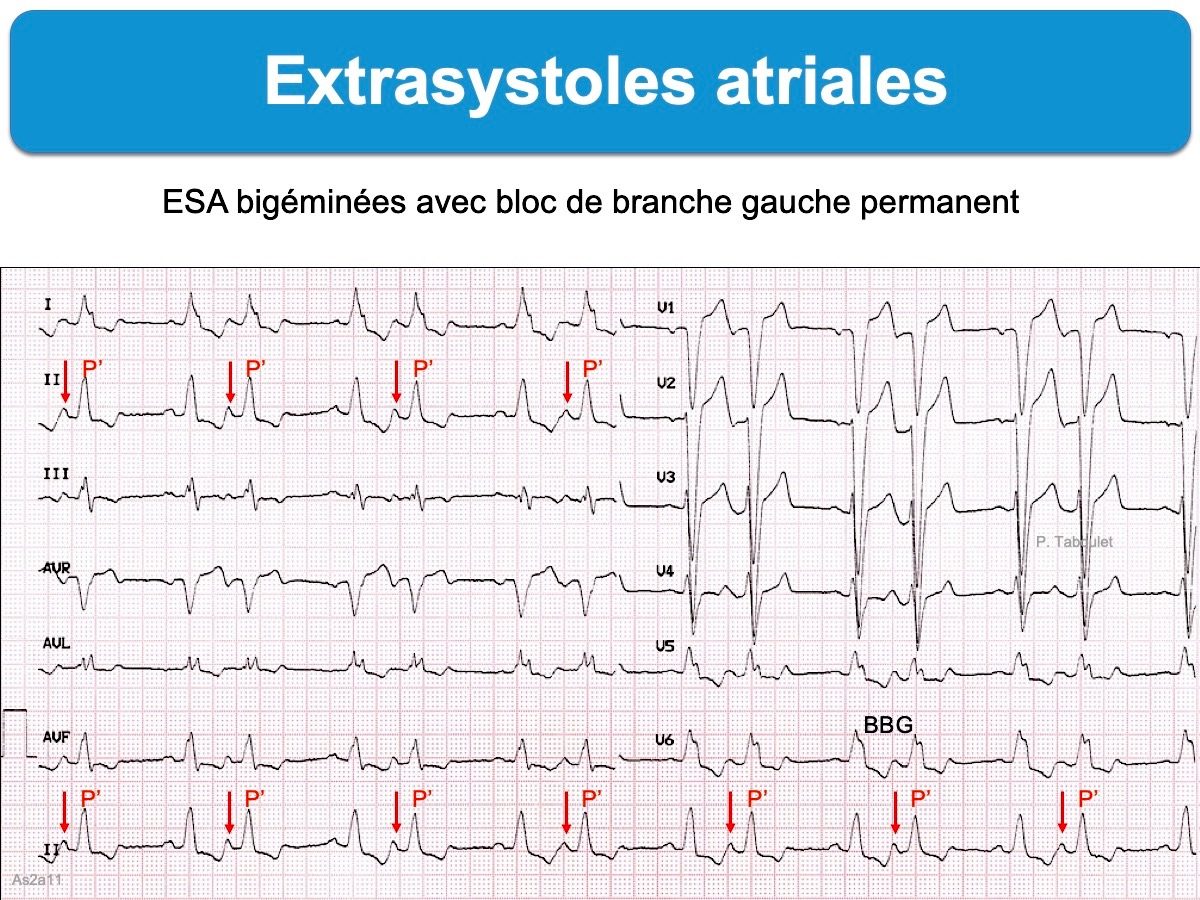 Extrasystole Atriale E cardiogram