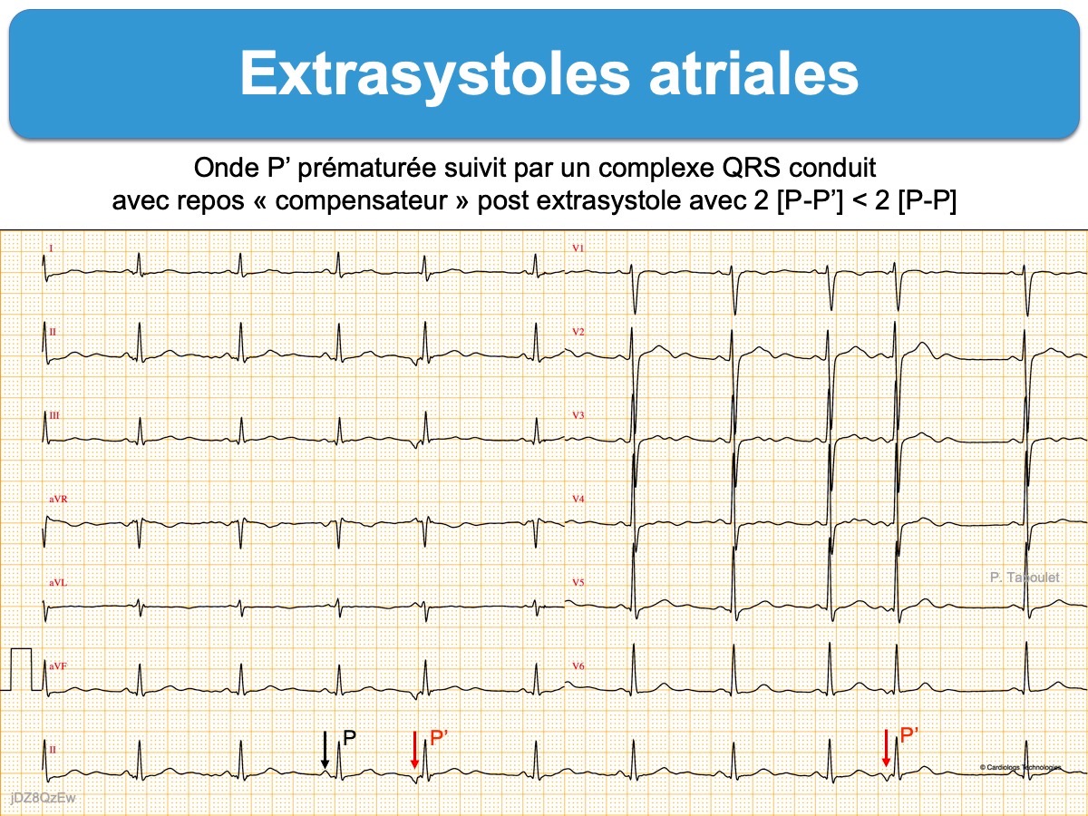 Extrasystole Atriale E Cardiogram