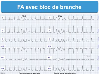 Fibrillation atriale 2. diagnostic ECG : e-cardiogram