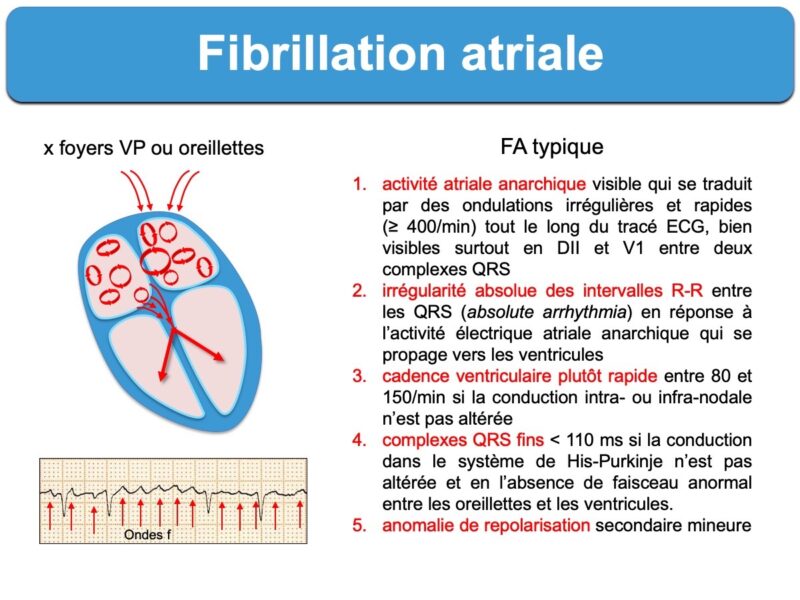 Traitement de la fibrillation atriale : le choc électrique , comment ça  marche ?