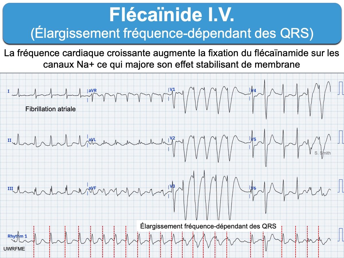 Flécaïnide : e-cardiogram