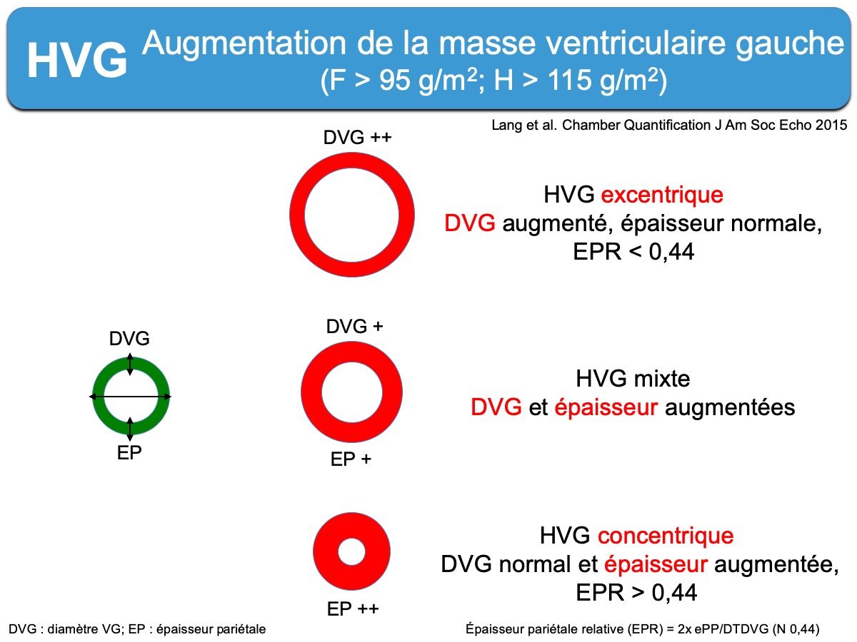 Hypertrophie Vg Hvg 1 Diagnostic E Cardiogram