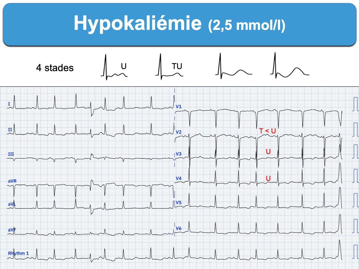 Hypokaliémie : e-cardiogram