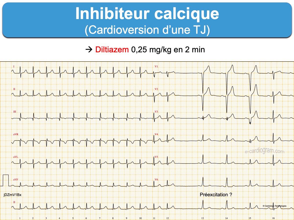 Inhibiteurs calciques (nondihydroP) ecardiogram