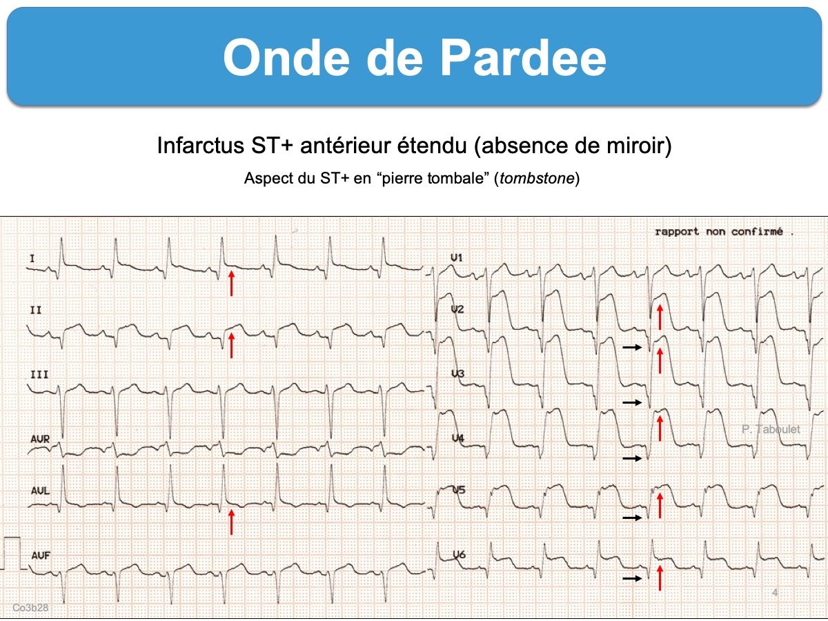 Onde De Pardee E cardiogram