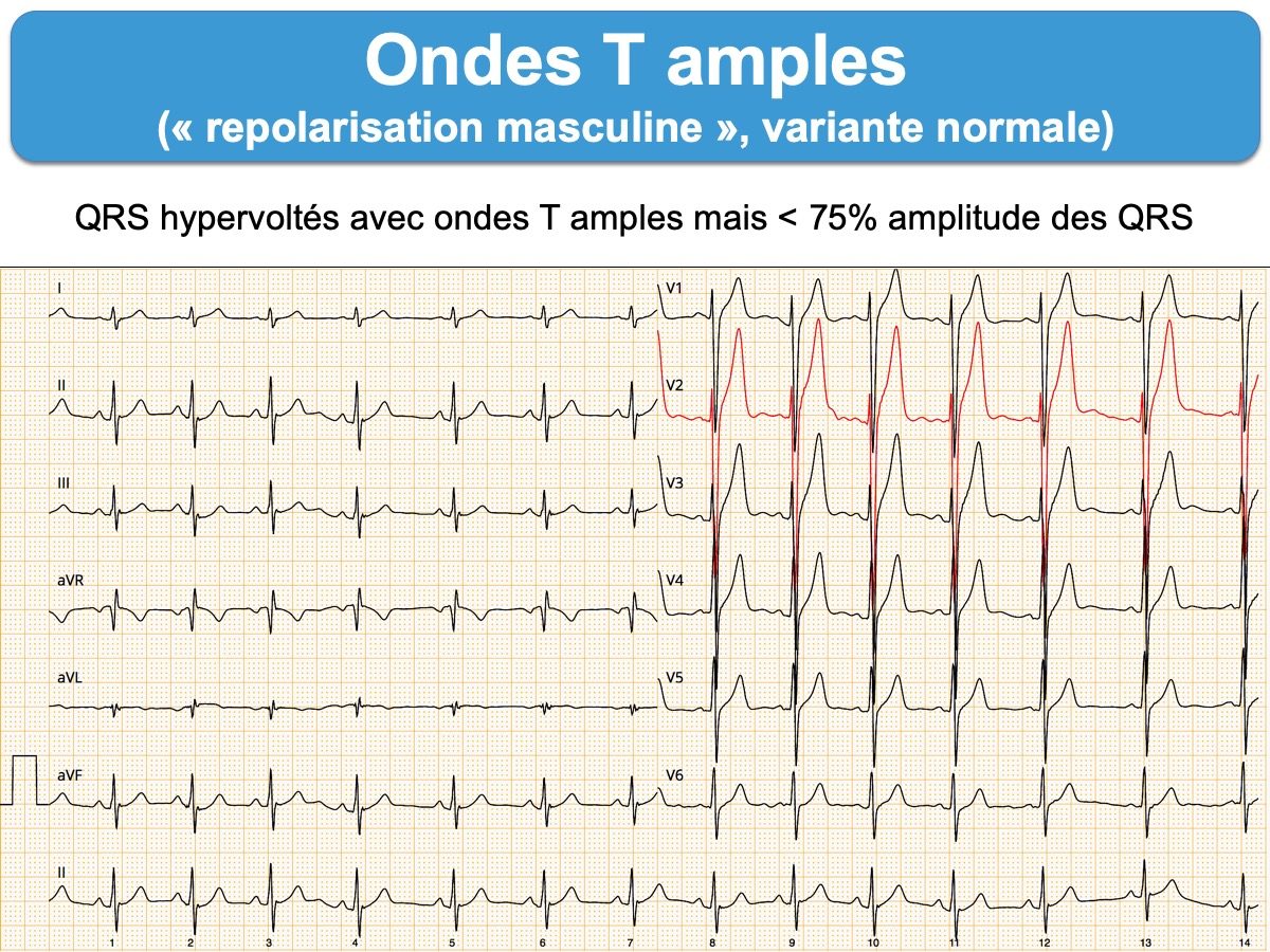 Onde T Ample E cardiogram onde-t-ample-e-cardiogram
