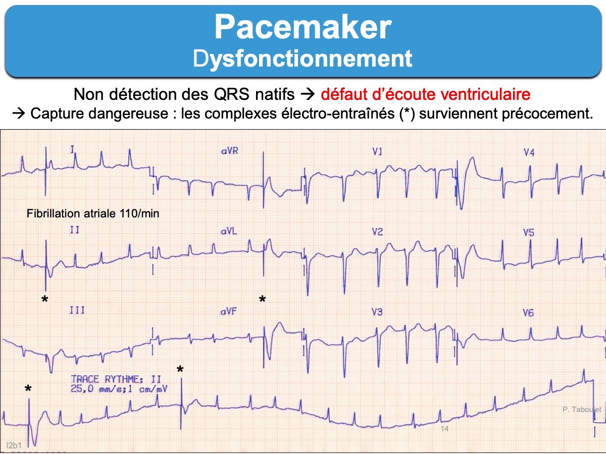 Pacemaker 5. Dysfonctionnement : e-cardiogram