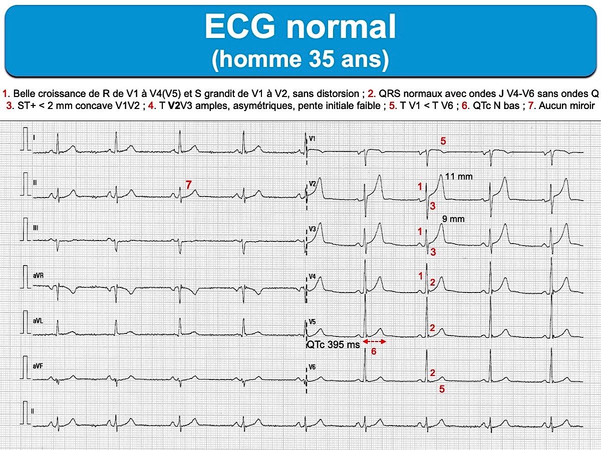 Variantes Repolarisation Ventriculaire E Cardiogram