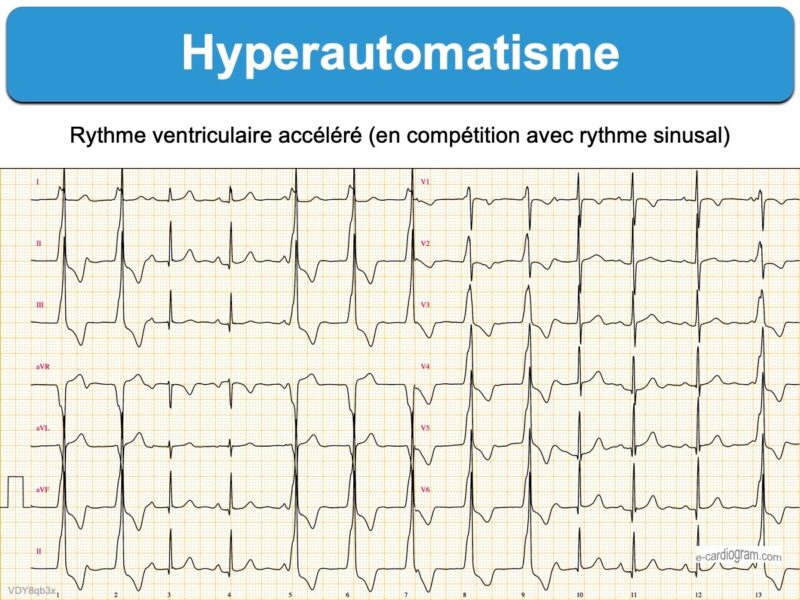 Ritmo Riva Rythme idioventriculaire accéléré (RIVA) : e-cardiogram