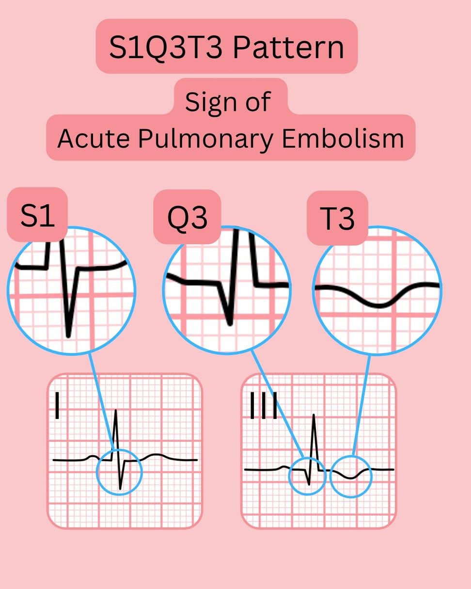 S1Q3 : e-cardiogram