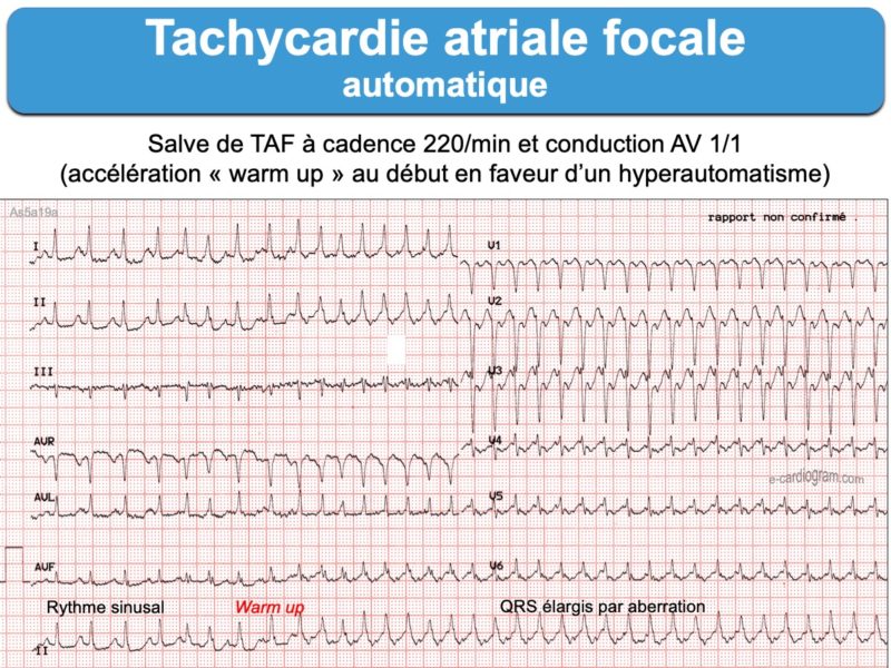 Tachycardie atriale 3. Automatique ecardiogram