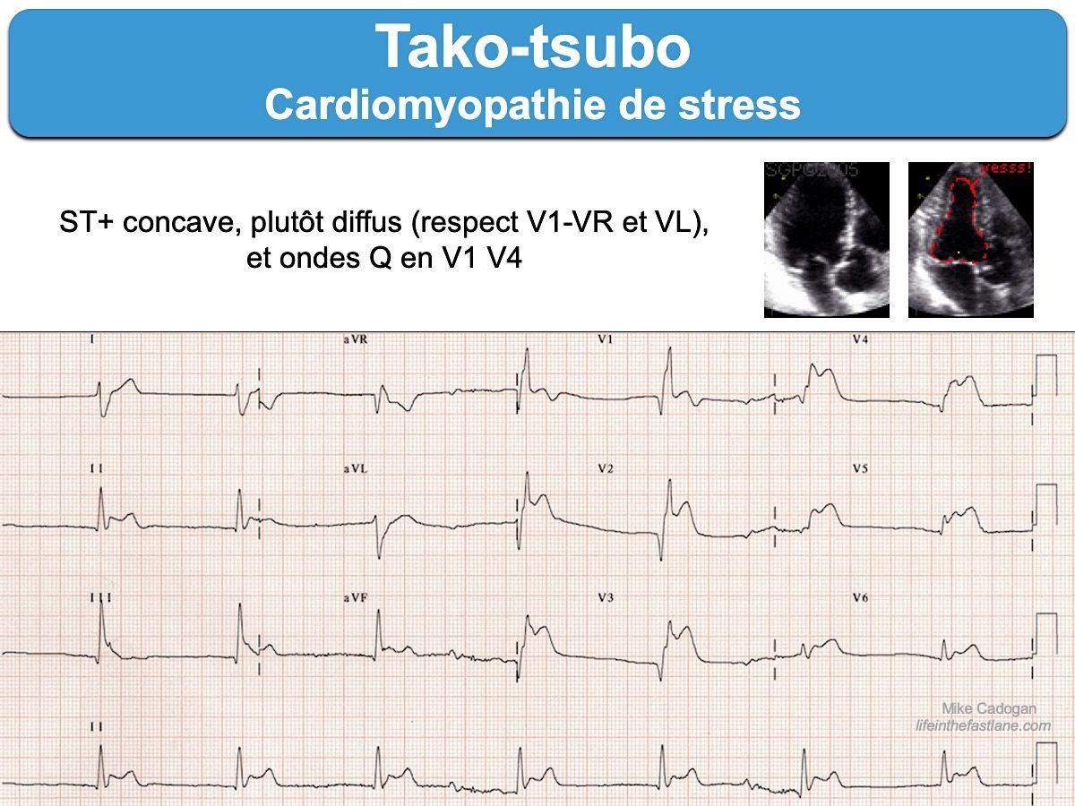 tako tsubo ecg