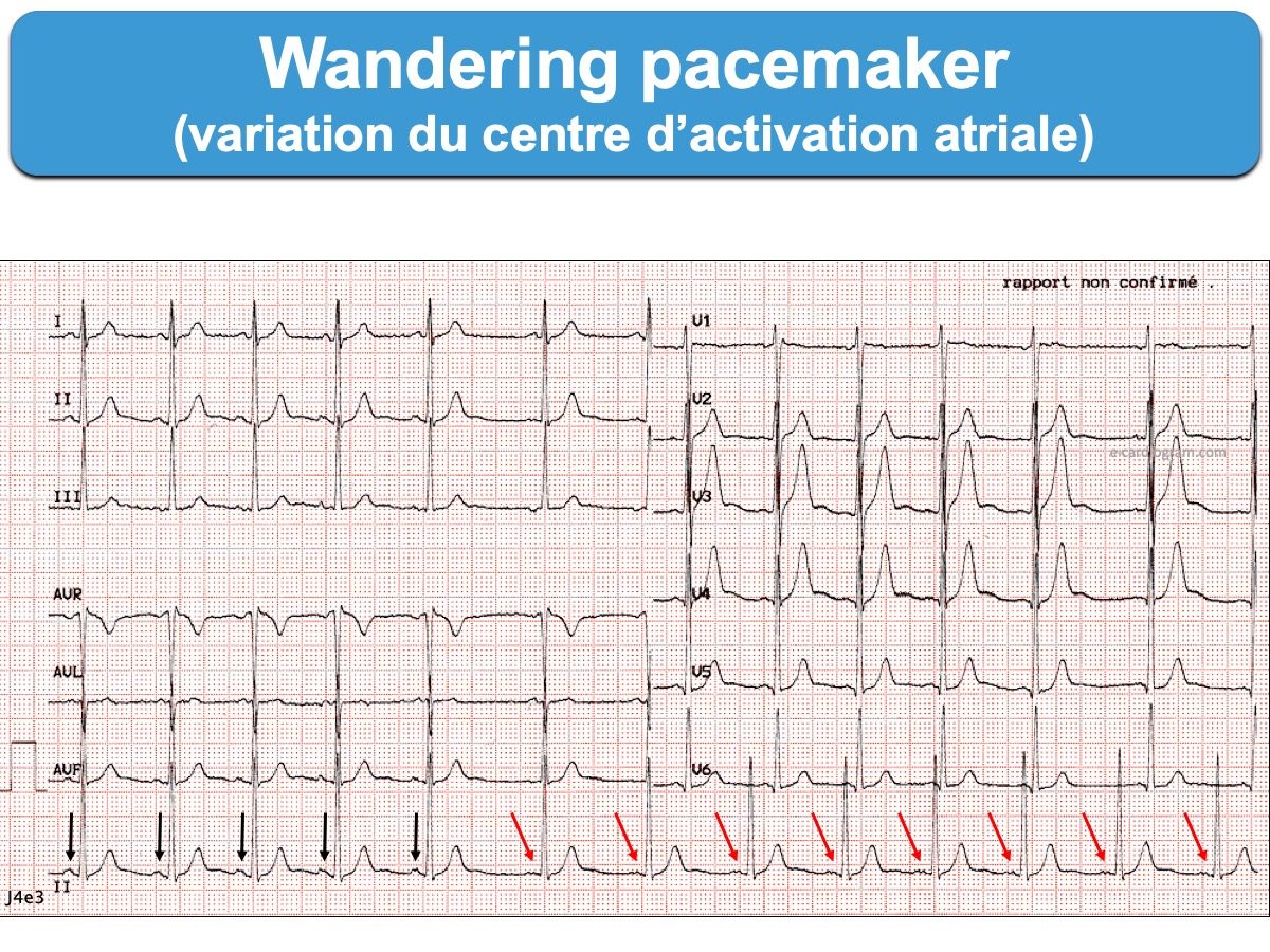 wandering pacemaker characteristics