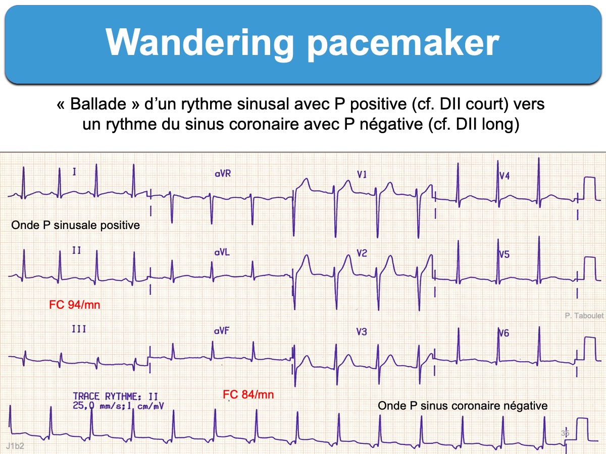 wandering pacemaker translation