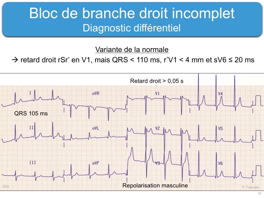 Bloc De Branche 2 Droit Incomplet E cardiogram bloc-de-branche-2-droit-incomplet-e-cardiogram