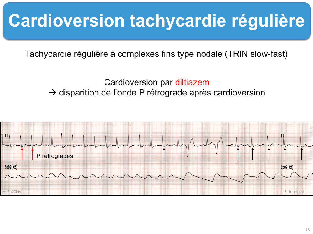 Cardioversion tachycardie régulière ecardiogram