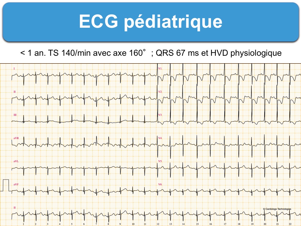 ECG Enfant p diatrie E cardiogram ECG Enfant p diatrie E cardiogram