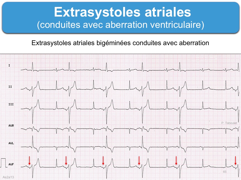 Extrasystole Atriale Aberration E cardiogram