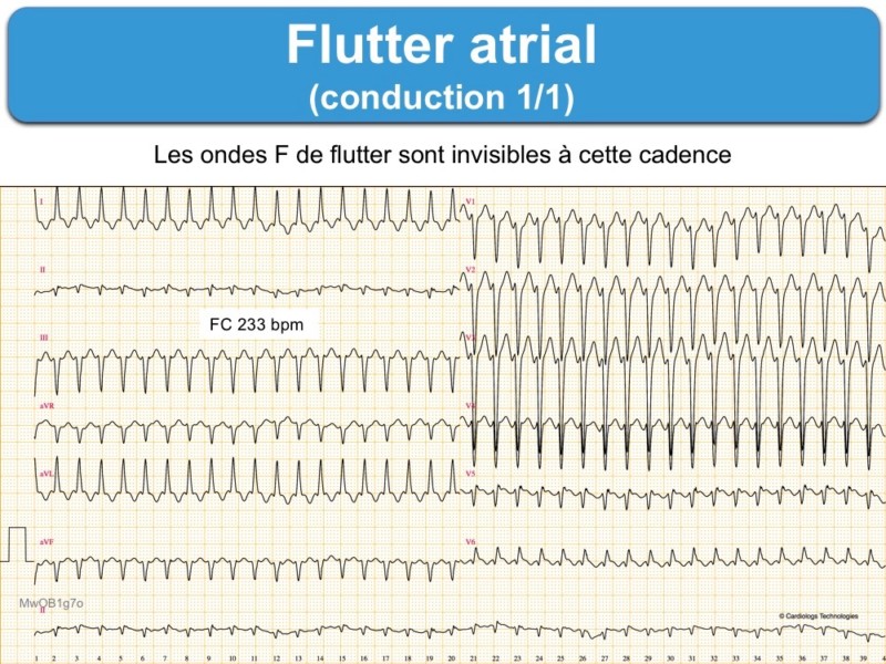 Flutter atrial 1. ECG : e-cardiogram