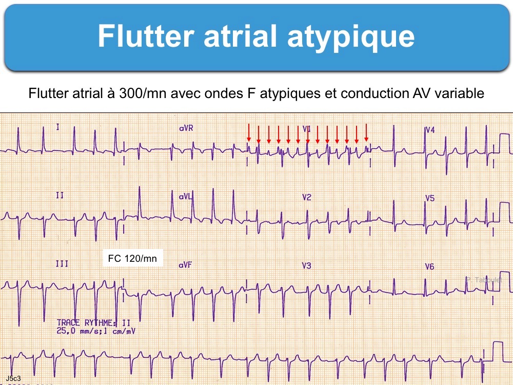 Atrial Flutter Ecg