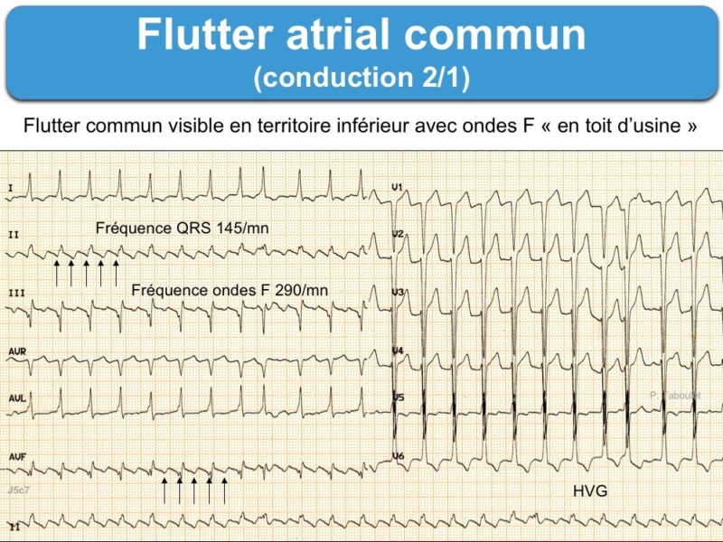 An ECG reading, symbolizing the heartbeat of Batman, with the atrial flutter representing the turmoil and chaos that he faces, much like the fluctuations in an ECG reading