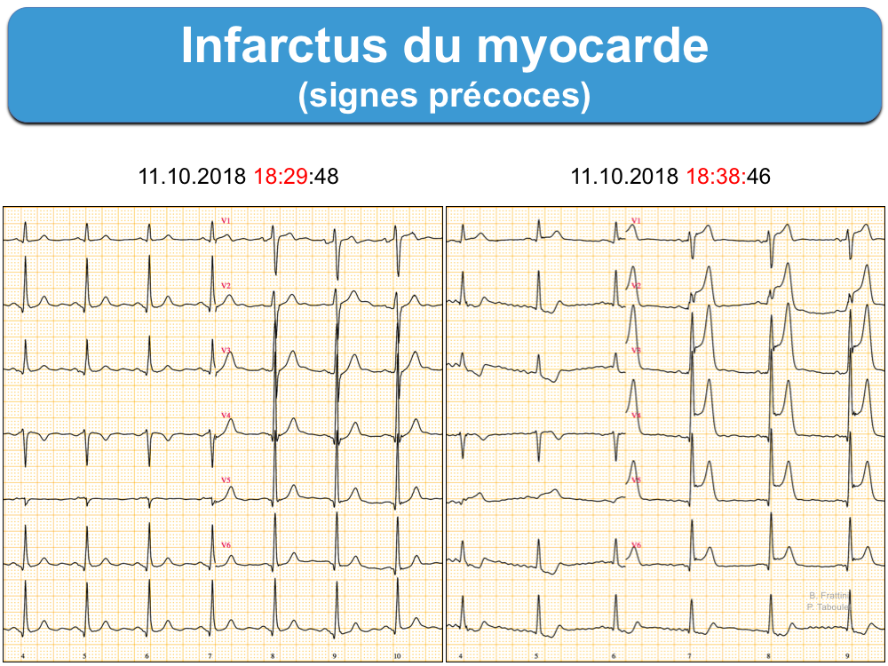 Infarctus 1 Généralités E Cardiogram