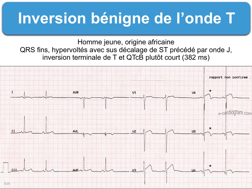 Inversion bénigne de l’onde T ecardiogram