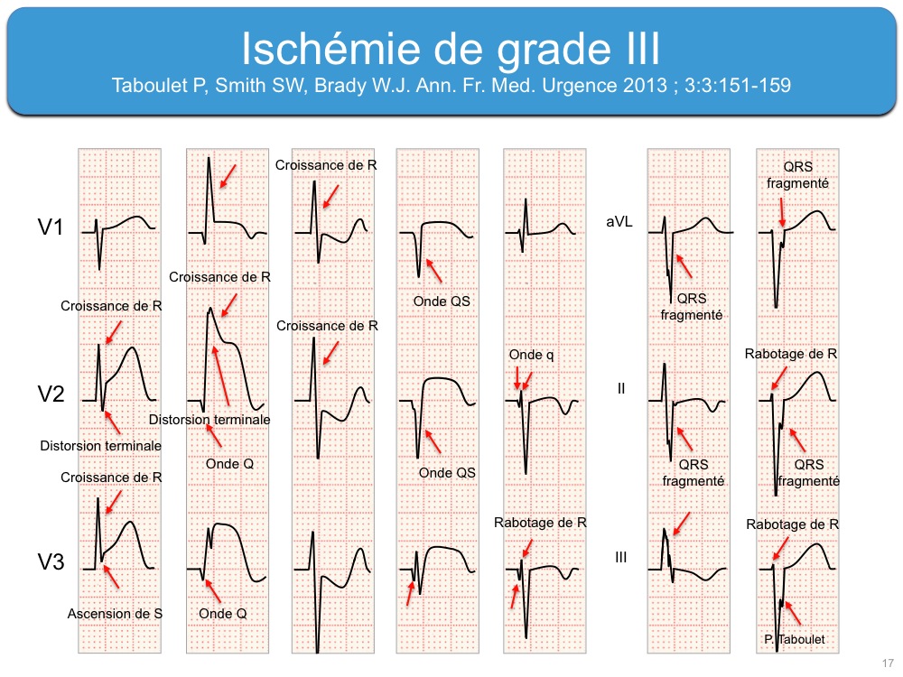 Ischémie myocardique : e-cardiogram