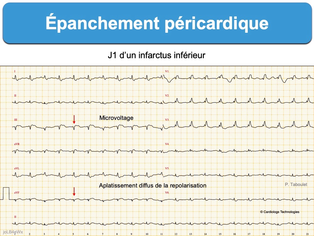 Épanchement péricardique : e-cardiogram
