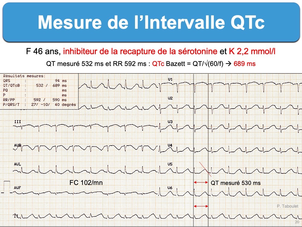 Scrieti Sub Forma De Intervale Multimile Intervalle QT. 3a. QT corrigé (QTc) : e-cardiogram