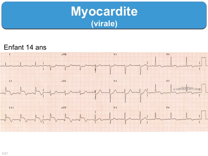 Myocardite : e-cardiogram