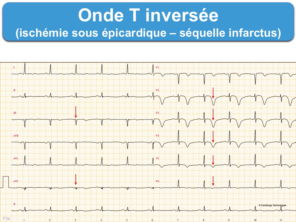 Onde T inversée ecardiogram