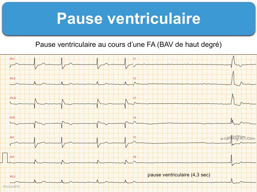 pause-e-cardiogram