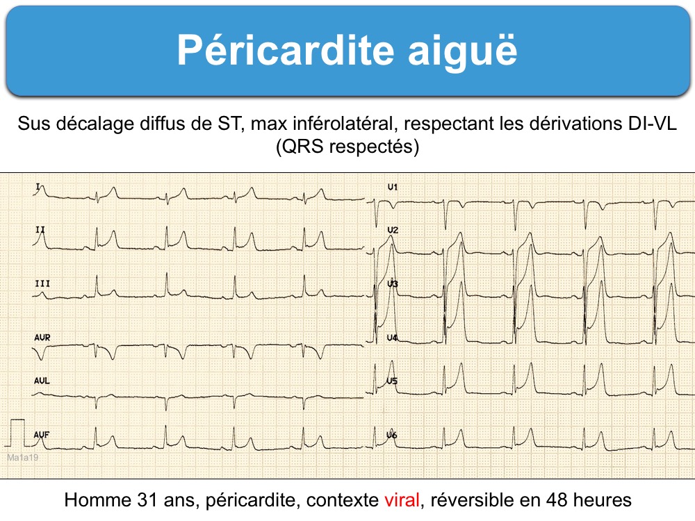 Péricardite aiguë. 1 typique : e-cardiogram