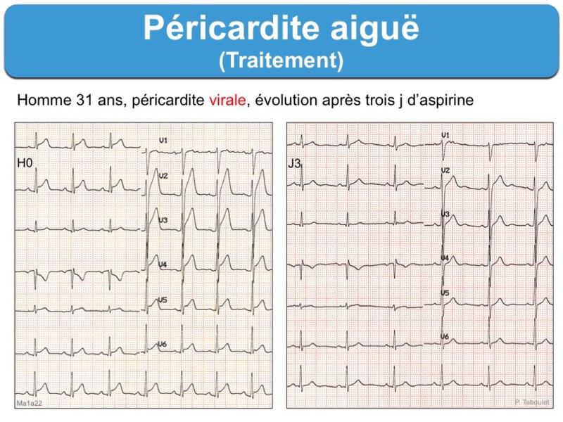 Péricardite aiguë. 3 bilan et traitement ecardiogram