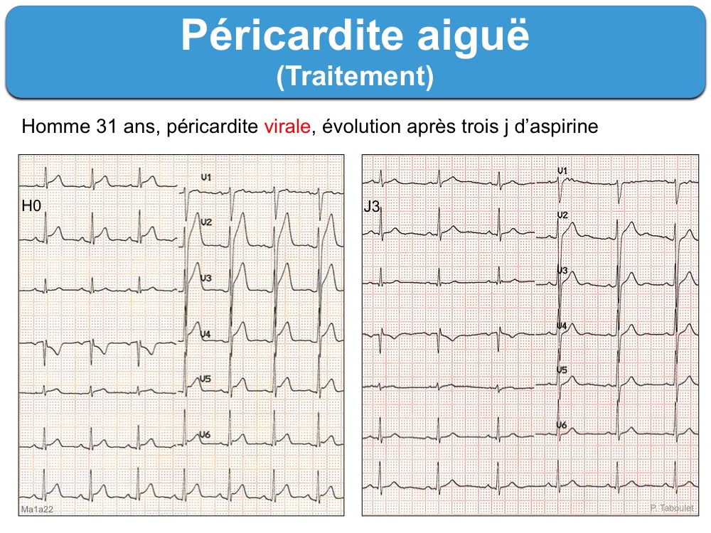Péricardite aiguë. 3 bilan et traitement : e-cardiogram