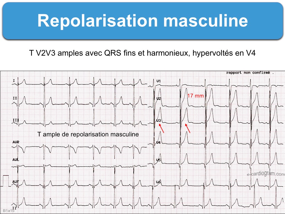 Repolarisation masculine : e-cardiogram