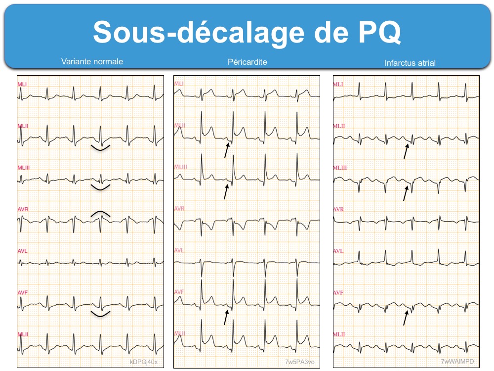 Sous-décalage de PQ (ou PR) : e-cardiogram