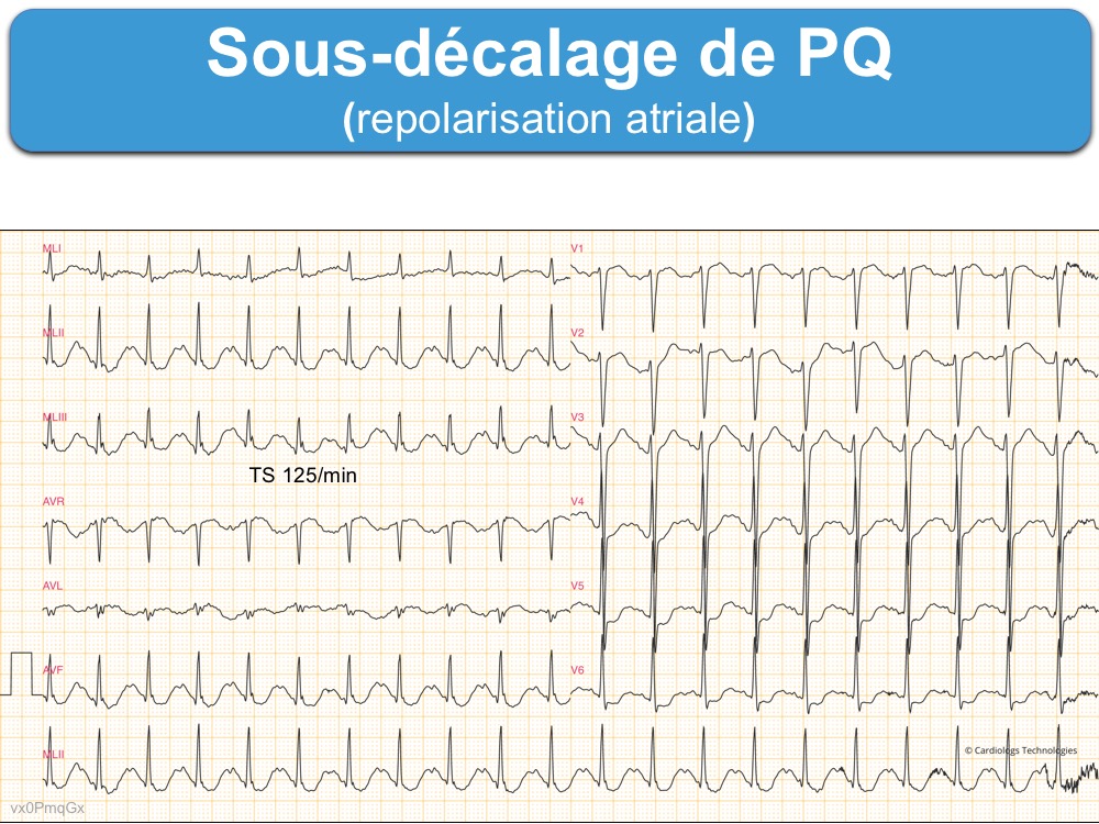 Sous-décalage de PQ (ou PR) : e-cardiogram