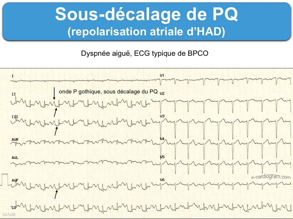Sous-décalage de PQ (ou PR) : e-cardiogram