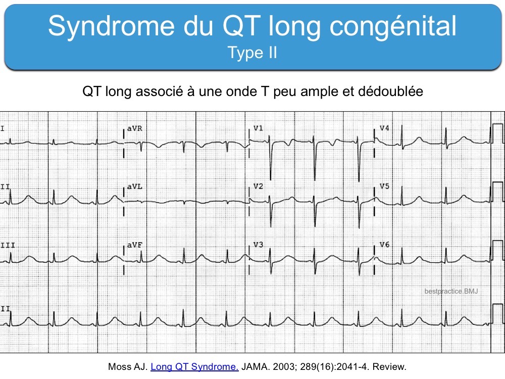 Qt q. Long qt Syndrome. Congenital long qt Syndrome. Синдром короткого qt. Синдром QS qt.